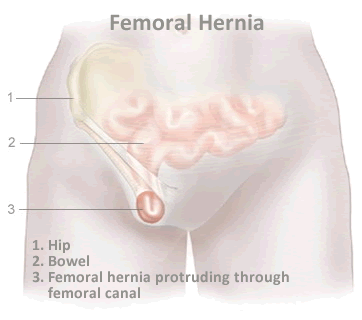 femoral-hernia_illustration.gif-2e